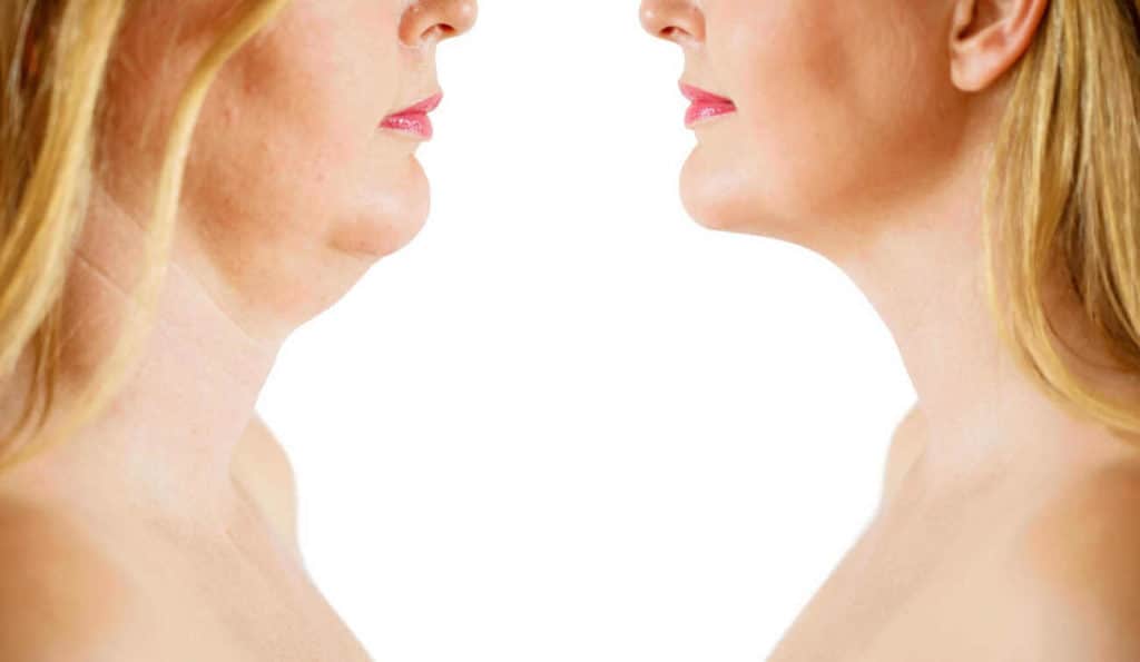 Double Chin treatment Higham Hill before and after results