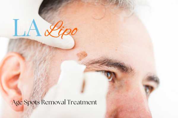 What Are the Most Effective Treatments for Age Spots Higham Hill?