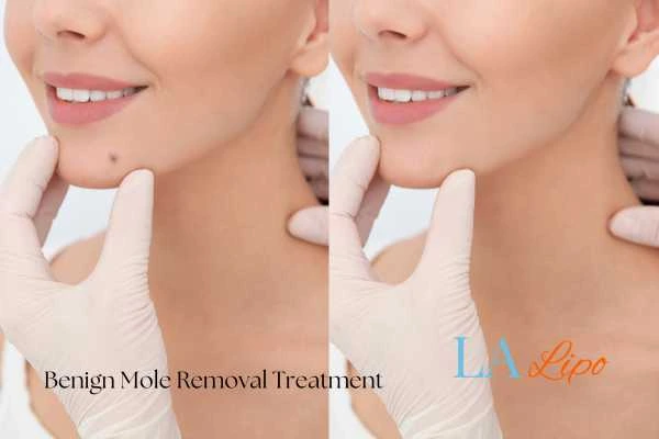 woman's before and after mole removal Higham Hill results