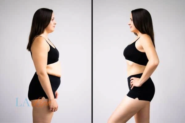 image of woman before and after results of LA-EMS Body Sculpting Higham Hill to help treat Diastasis recti