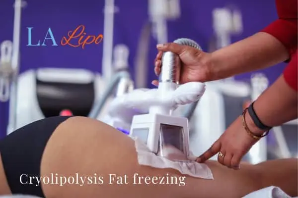 women getting fat freezing Higham Hill