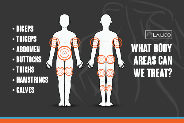 Graphic to show areas you can have LA-EMS Body Sculpting Higham Hill treatment.