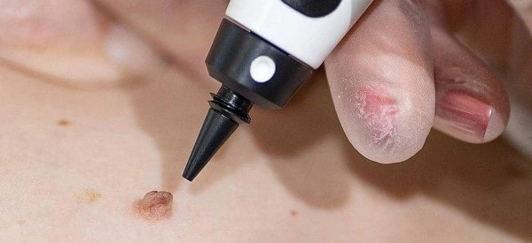 skin tag removal using cryopen Higham Hill