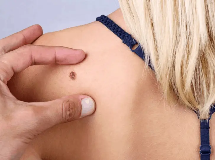 woman having mole removal Higham Hill consultation before treatment.