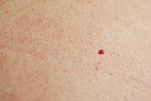 close up of a cherry angioma Higham Hill