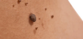image of a skin tag Higham Hill