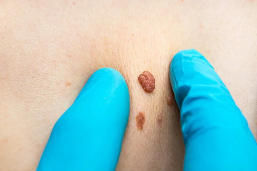 Consultant examining a skin tag Higham Hill