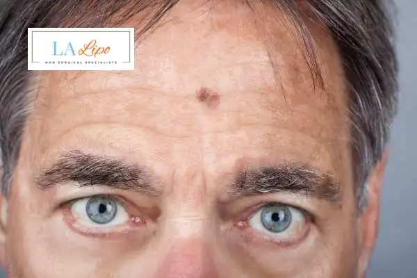 Solar Lentigo Removal Higham Hill image of man with mark on his forehead