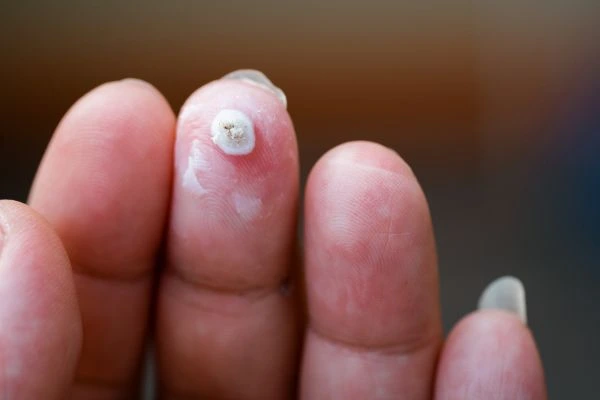 wart on person finger - cryotherapy to treat from LA LIPO Higham Hill