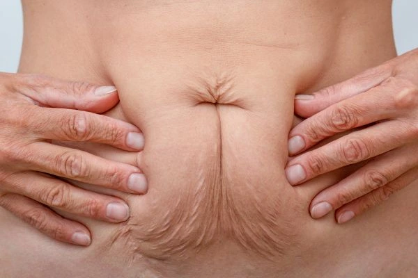 Should I Combine Diastasis Recti Treatment with Body Contouring for Better Results Higham Hill?