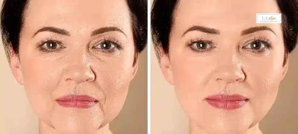 How Long Does It Take to See Results and How Long Do They Last Higham Hill?