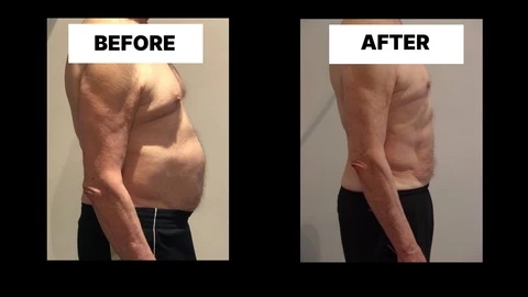What Symptoms Can Diastasis Recti Cause in Men? Weak Core, Back Pain and Poor Posture Higham Hill